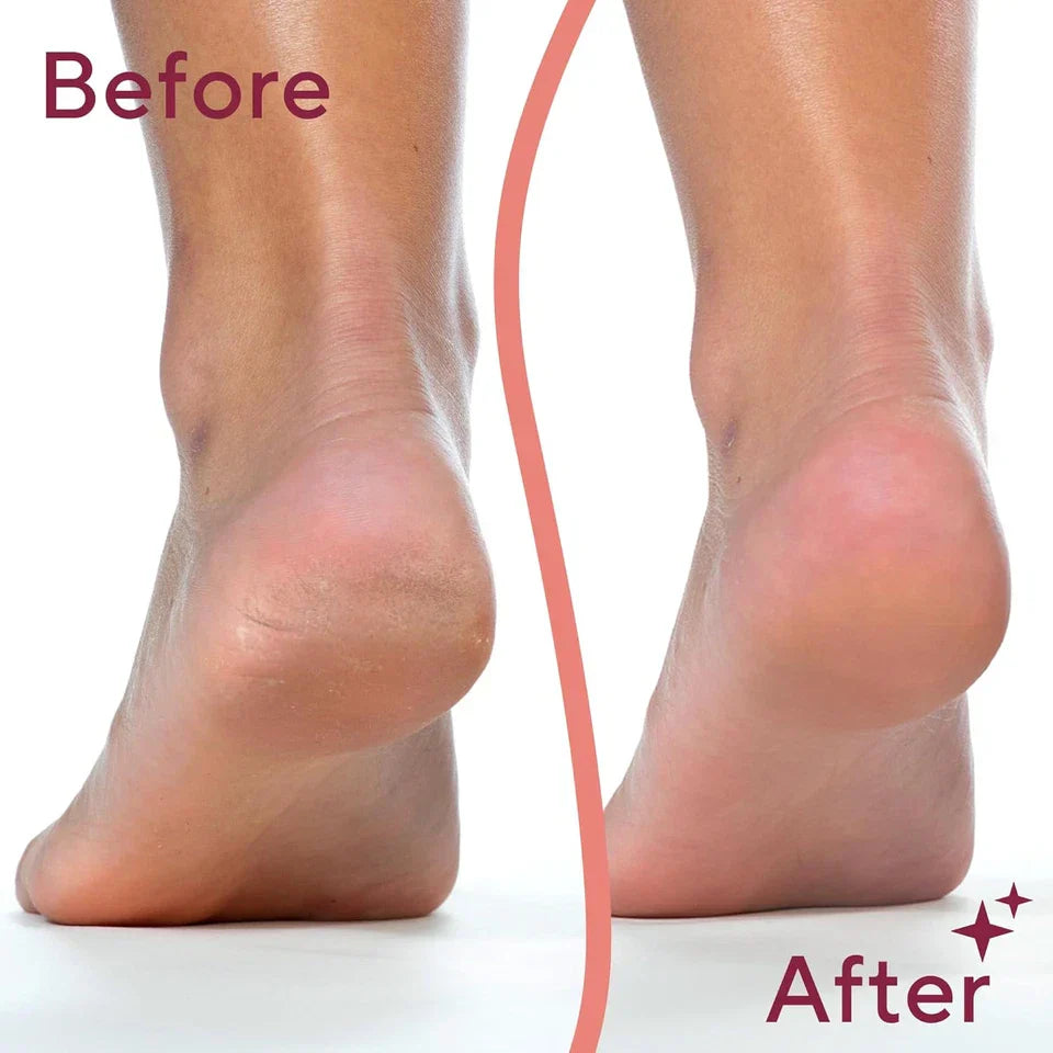 Rechargeable Electric Pedi Foot Filer – Callus Remover for Soft & Smooth Feet